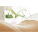 acupuntura para dor nas costas agendar Vila Ré