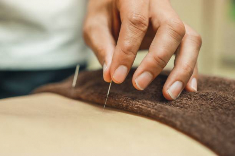 acupuntura-nas-costas