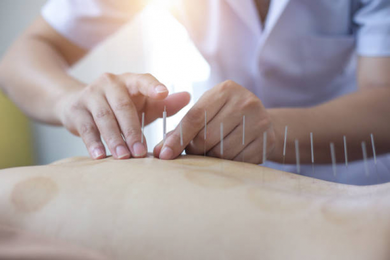 Acupuntura Estética Facial Vila Graciosa - Acupuntura para Dor na Coluna