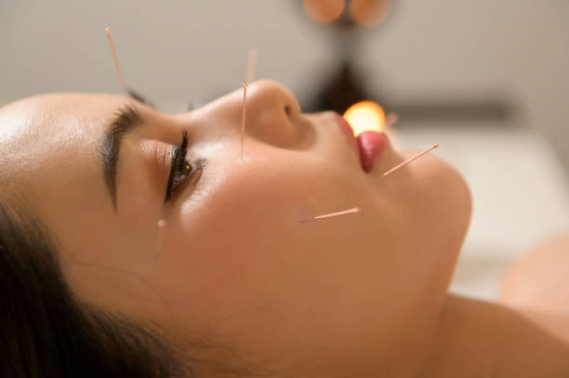 Acupuntura para Neuropatia Jardim Angélica - Acupuntura Estética Facial