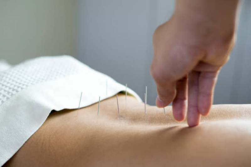 Onde Fazer Acupuntura Estética Facial Carandiru - Acupuntura Zona Norte de São Paulo