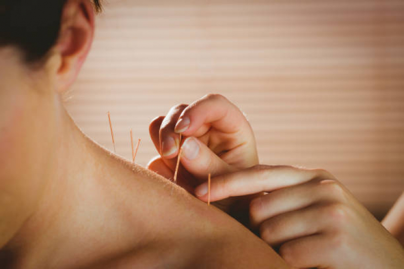 Sessão de Acupuntura para Dor Lombar Vila Rosália - Acupuntura Estética Facial