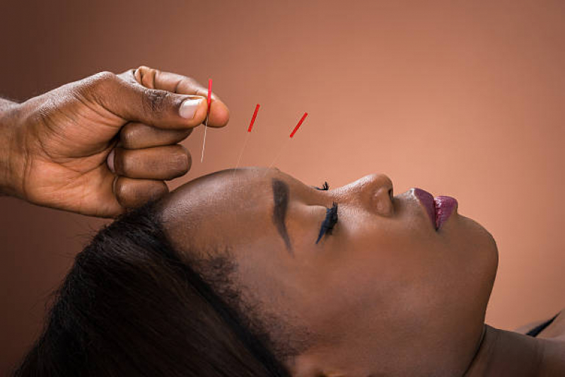 Sessão de Acupuntura Tradicional Chinesa Parque Novo Mundo - Acupuntura Estética Facial